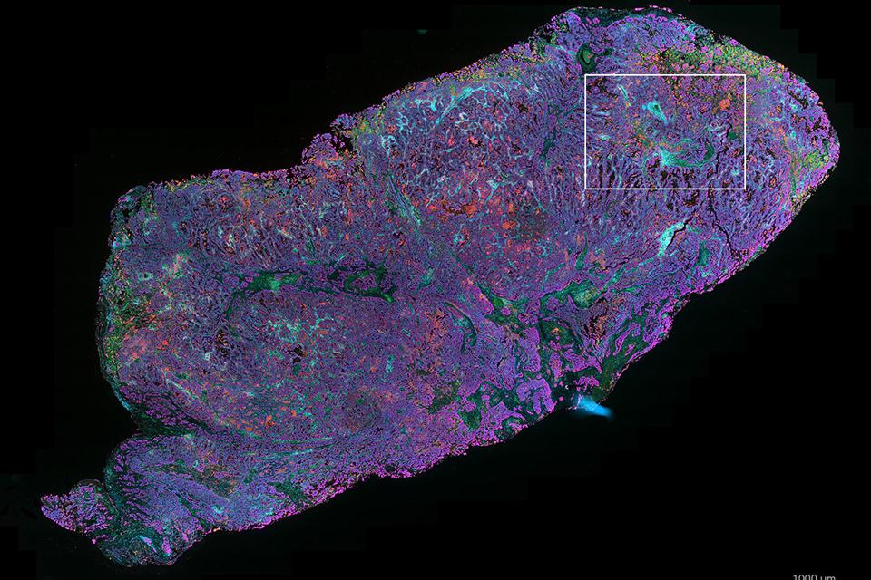 NSCLC tissue stained with UltiMapper I/O PD-L1 kit.