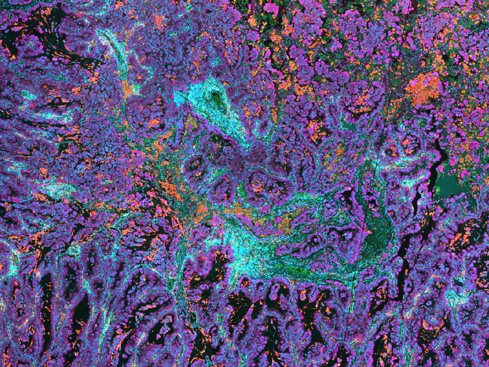 Tissu NSCLC coloré avec kit UltiMapper I/O PD-L1. Gros plan. Échantillon avec l'aimable autorisation de Ultivue, Inc. Cambridge, Massachusetts, États-Unis