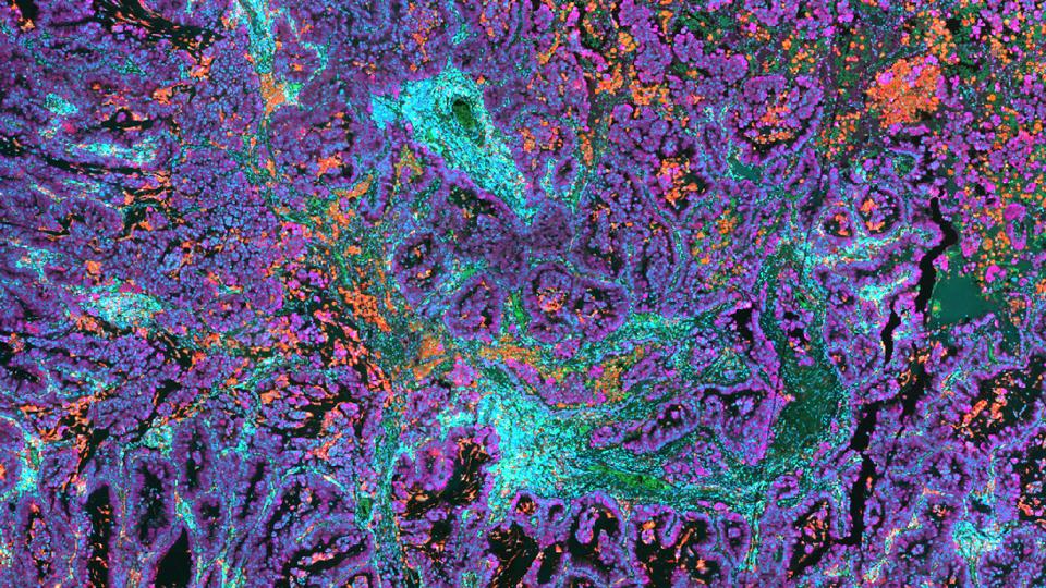 NSCLC tissue stained with UltiMapper I/O PD-L1 kit. Picture detail.