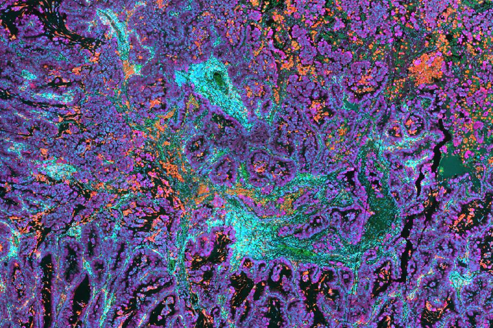NSCLC tissue stained with UltiMapper I/O PD-L1 kit. Picture detail.