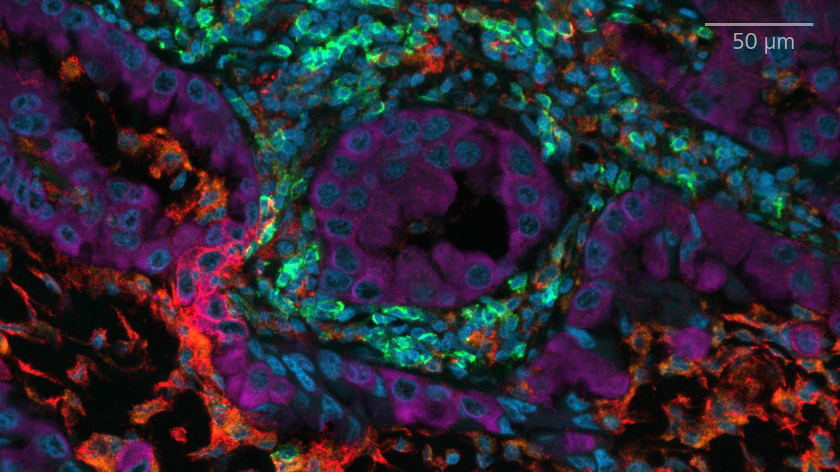 Gewebe eines nicht-kleinzelligen Bronchialkarzinoms (NSCLC), gefärbt mit UltiMapper I/O PD-L1 Kit. Probe mit freundlicher Genehmigung von Ultivue, Inc., Cambridge, Massachusetts, USA