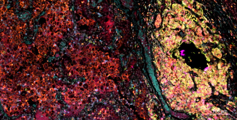 Lung Squamous Carcinoma tissue mIF staining for CD4/CD8/CD20/PD-1/CTLA-4/FoxP3/DAPI using Opal 7-color kit