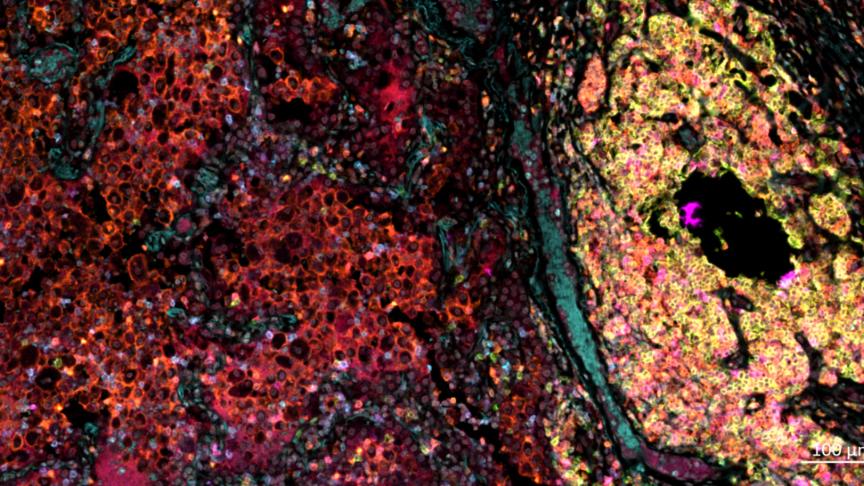 Lung Squamous Carcinoma tissue mIF staining for CD4/CD8/CD20/PD-1/CTLA-4/FoxP3/DAPI using Opal 7-color kit