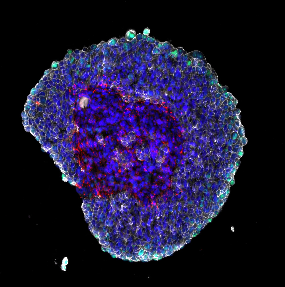 Colon cancer spheroid co-cultured with fibroblasts. FFPE sections stained for Filaggrin, Ki67, Collagen-1, E-cadherin, DAPI. The spheroids were grown, fixed, paraffin embedded, cut and stained at Bioneer A/S (Hørsholm, Denmark)