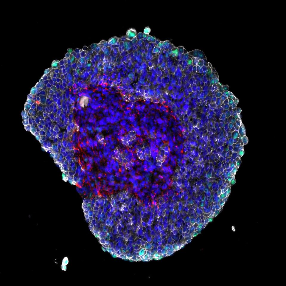 Colon cancer spheroid co-cultured with fibroblasts. FFPE sections stained for Filaggrin, Ki67, Collagen-1, E-cadherin, DAPI. The spheroids were grown, fixed, paraffin embedded, cut and stained at Bioneer A/S (Hørsholm, Denmark)