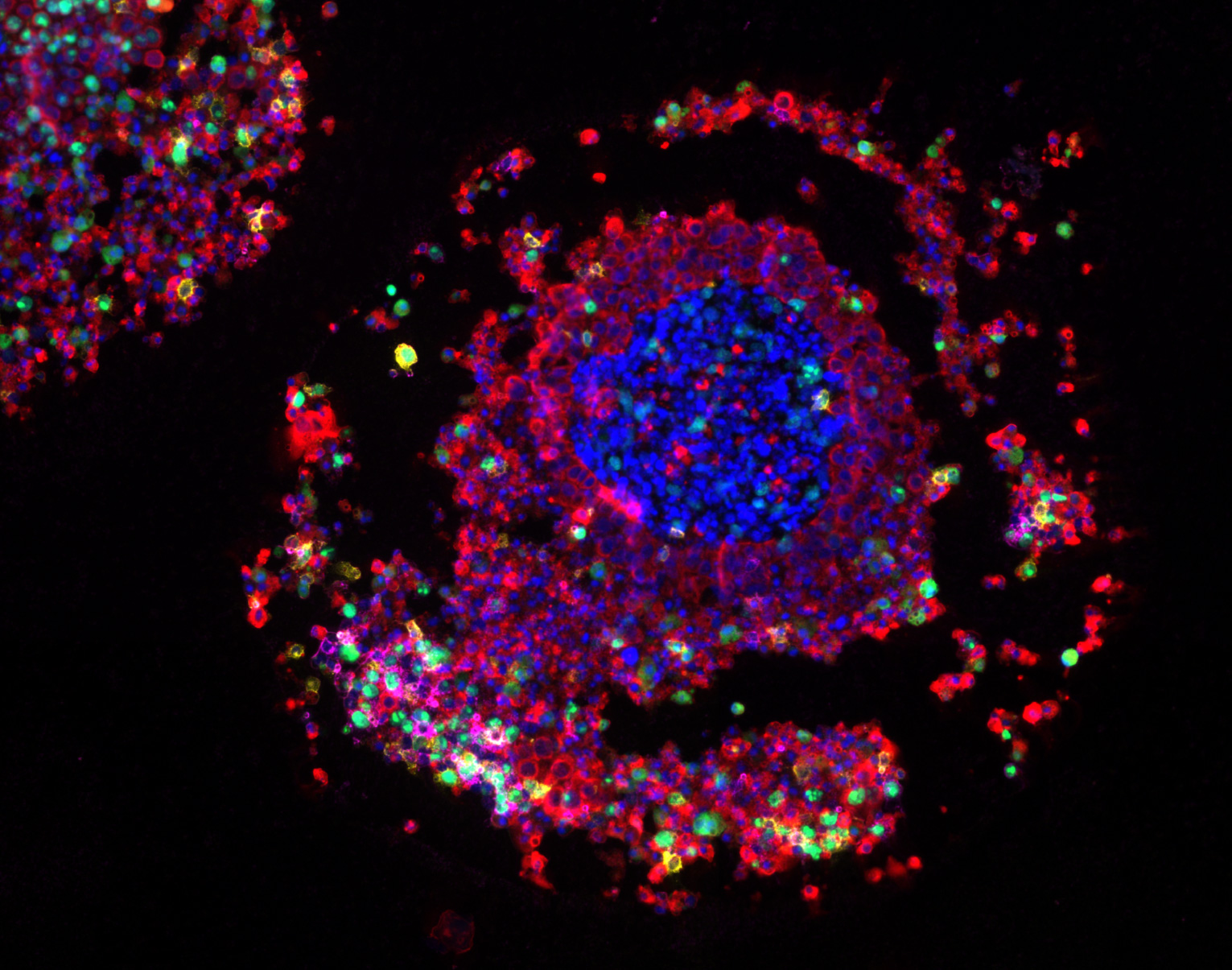 The cancer spheroid shown here contains HT29 colon cancer cells, fibroblasts and bead-activated T cells, and shows a partly disintegrated spheroid structure, where the damage is caused by cytotoxic T-cells (CD8 positive, yellow).