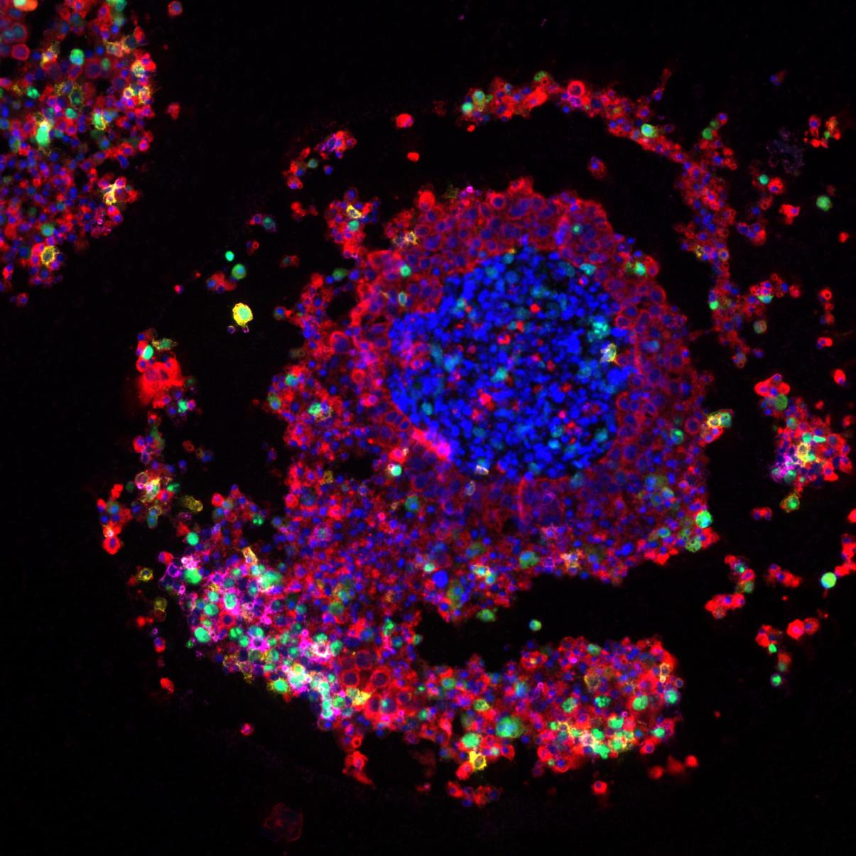 The cancer spheroid shown here contains HT29 colon cancer cells, fibroblasts and bead-activated T cells, and shows a partly disintegrated spheroid structure, where the damage is caused by cytotoxic T-cells (CD8 positive, yellow).