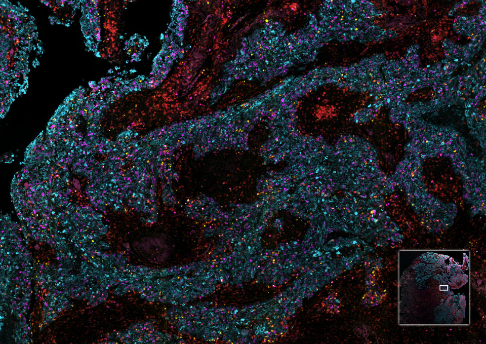 A composite image of Non-Small Cell Lung Cancer tissue, stained with Ki67, GranzymeB, CD3, CK/SOX10, DAPI.