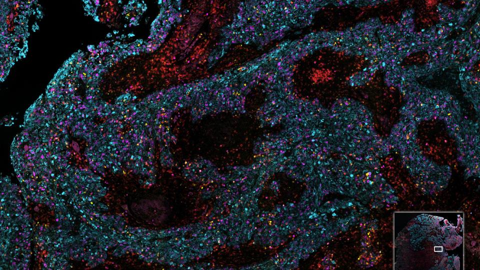 A composite image of Non-Small Cell Lung Cancer tissue, stained with Ki67, GranzymeB, CD3, CK/SOX10, DAPI.