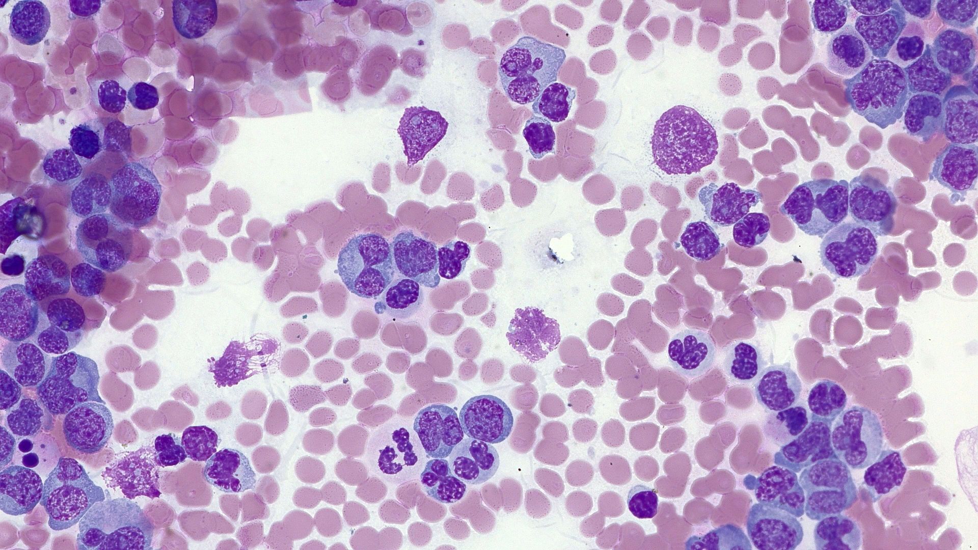 Representative image of human blood showing leukemia, Giemsa staining, transmitted light brightfield.