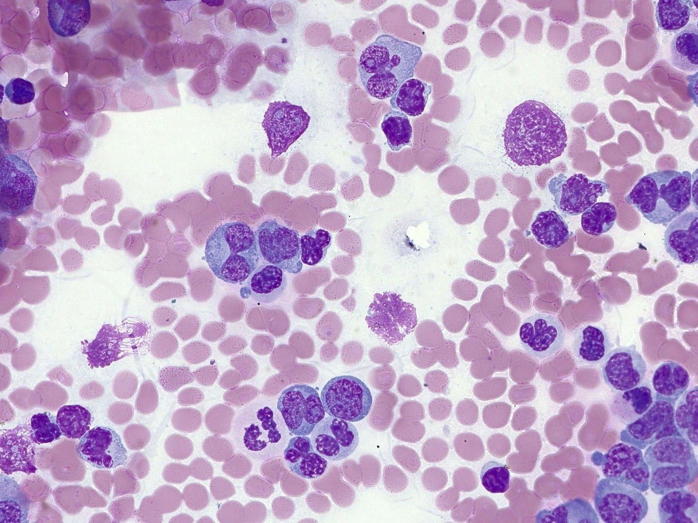 Representative image of human blood showing leukemia, Giemsa staining, transmitted light brightfield