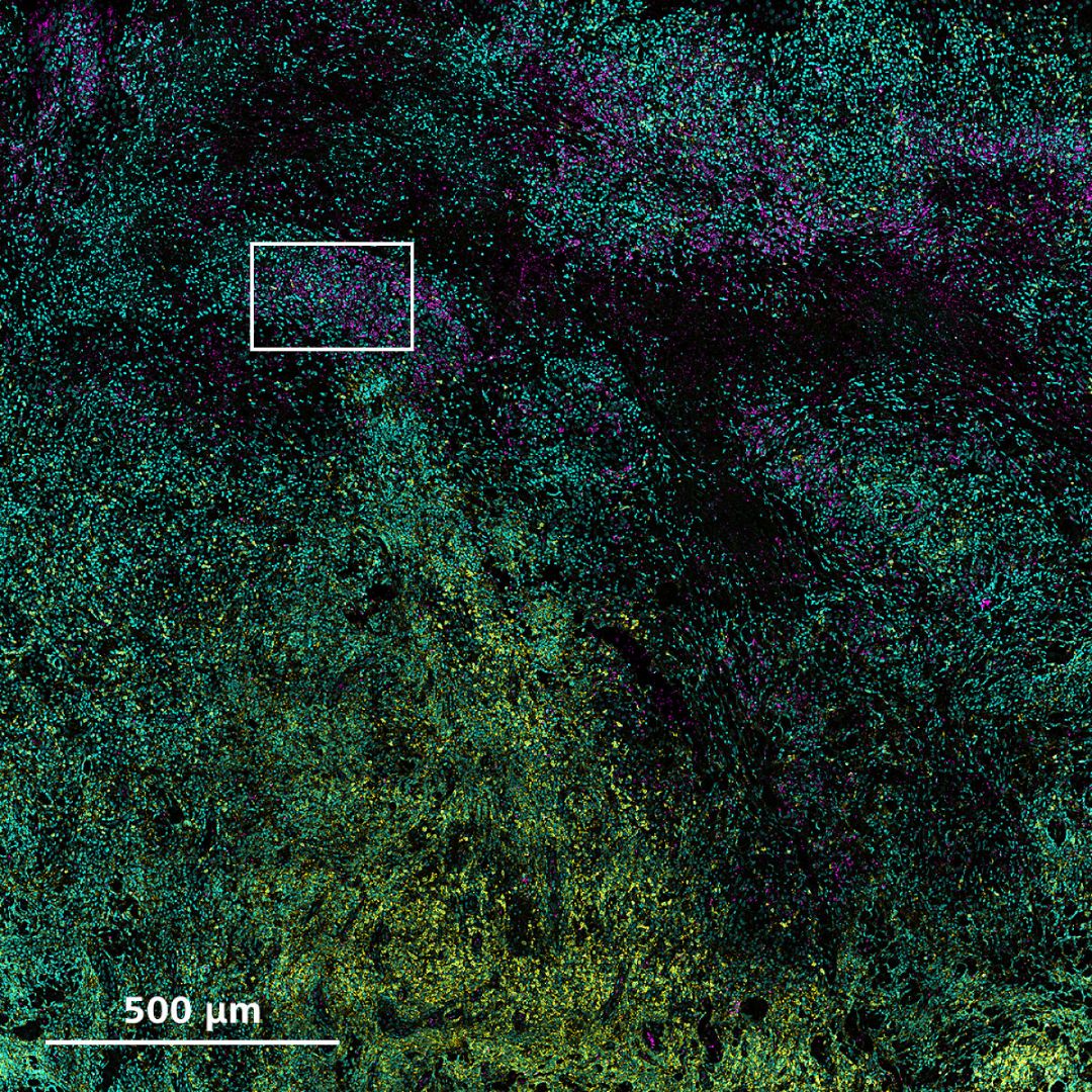 Hautgewebeschnitt, angefärbt auf Zellkerne (cyan), CD8‑Zellen (gelb) und Leishmanien (parasitäre Einzeller, magenta)