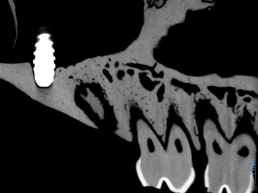 骨骼中的生物医用金属植入物。未使用MARS（左图），使用MARS（右图）。