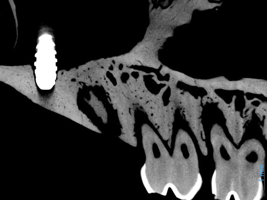 Implant métallique biomédical dans l'os. Sans MARS, à gauche. Avec MARS, à droite.