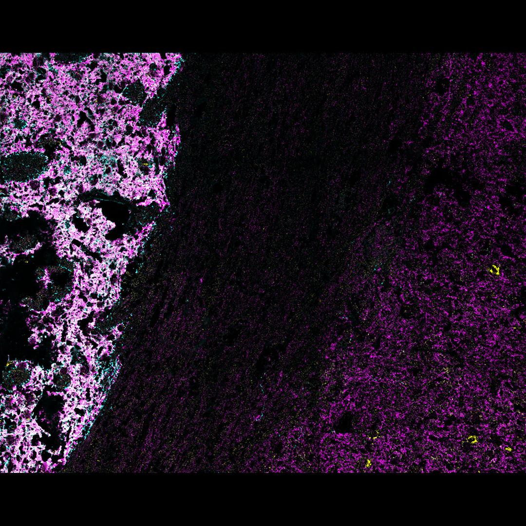 Figure 12: Three marker overlay. CAV2 (blue), GAD (yellow), and DAT (magenta)