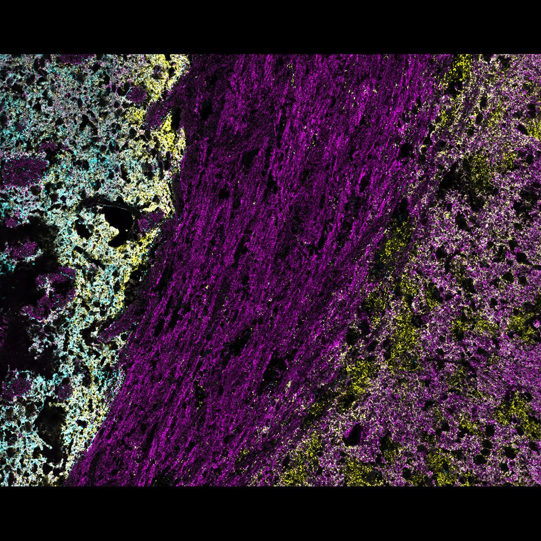 Figure 6: Three marker overlay. DAT (blue), Synaptophysin (yellow) and Syntaxin (magenta)