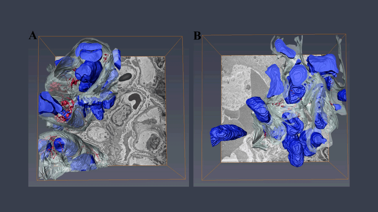 3D ultrastructure of the Fibers of the Elastic Fiber System (FEFS) shown in red, capillary in white, and cells in blue. Superior plane. Wild type (left) presents FEFS arranged in a tubular-shaped network (white arrow) within the capillary. MFS (right) presents fractured FEFS (black arrow), and loss of capillary structure.