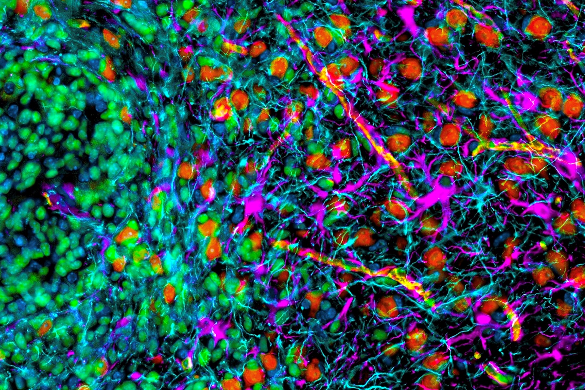 Hyper multiplexed (HIFI) image exploring the spatial biology of a mouse brain glioblastoma focused on the dynamic interface between the tumor and the surrounding brain.