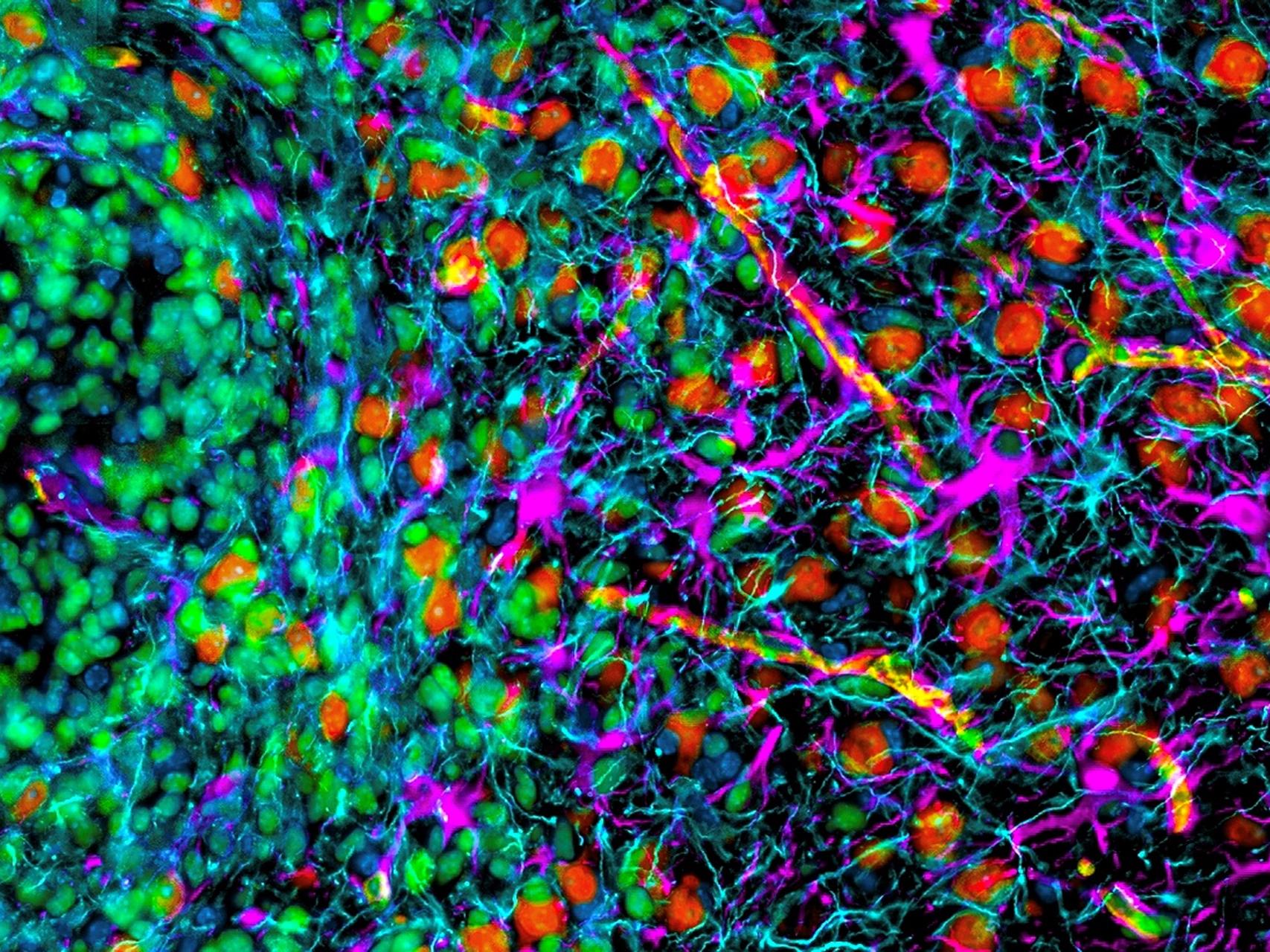 Hyper multiplexed (HIFI) image exploring the spatial biology of a mouse brain glioblastoma focused on the dynamic interface between the tumor and the surrounding brain.