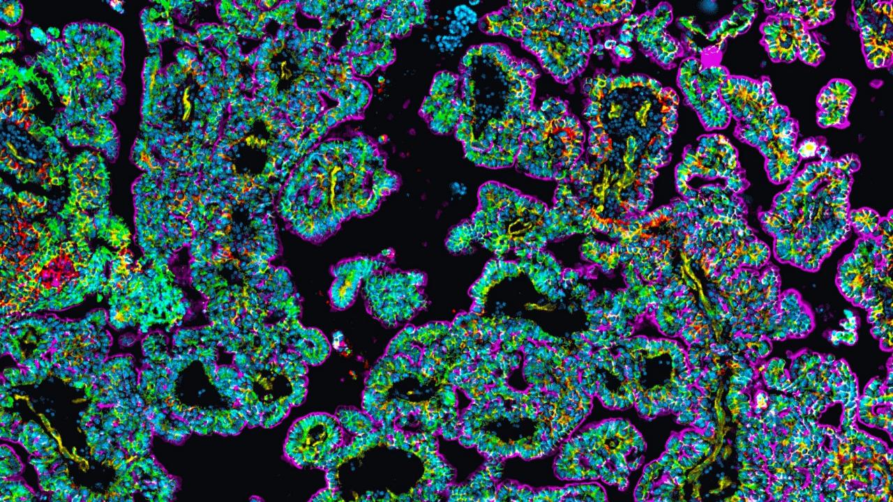 Hyperplexed Imaging Uncovers Brain Tumor Microenvironment Changes