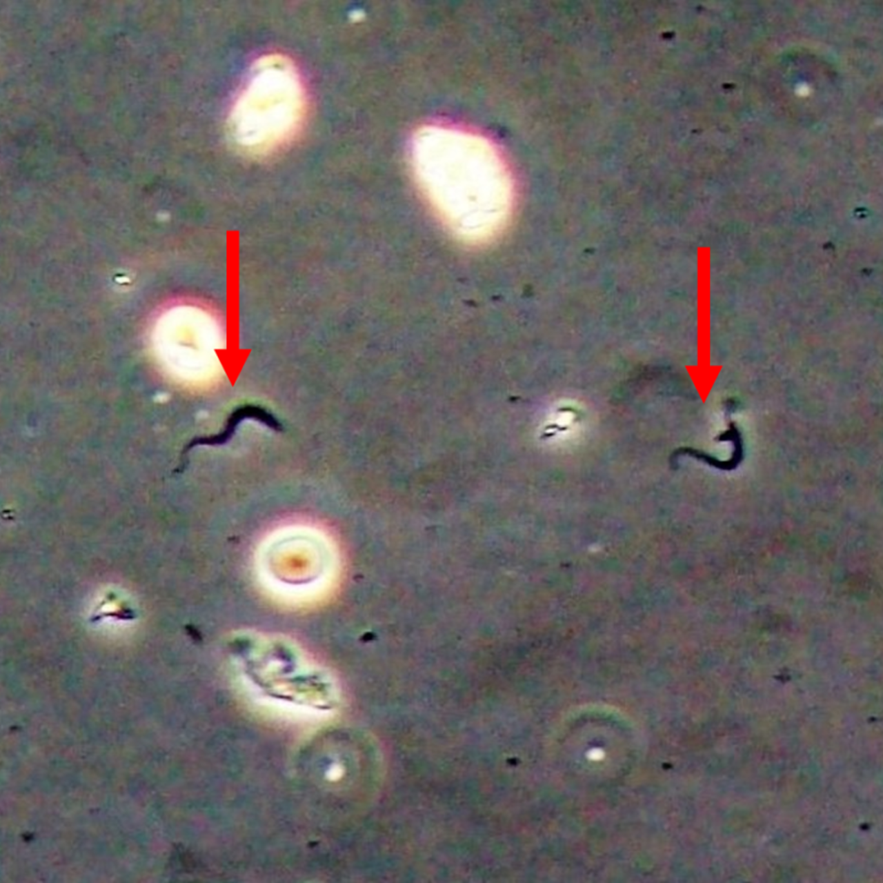 Trypanosoma cruzi trypomastigotes in the urine sediment imaged with phase contrast microscopy.
