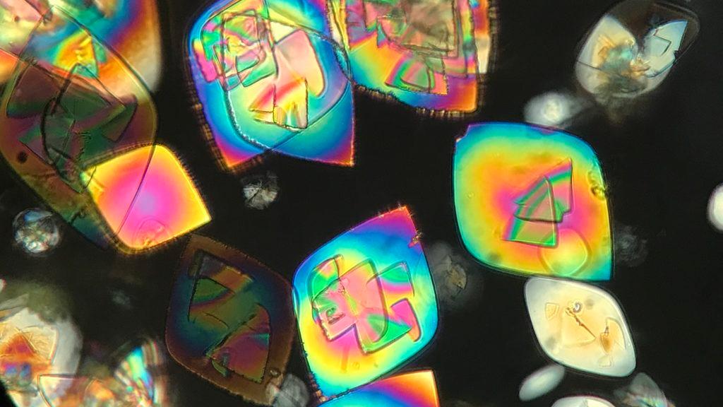 For the Love of Urinalysis: The Beauty of Clinical Microscopy of Urine Sediment