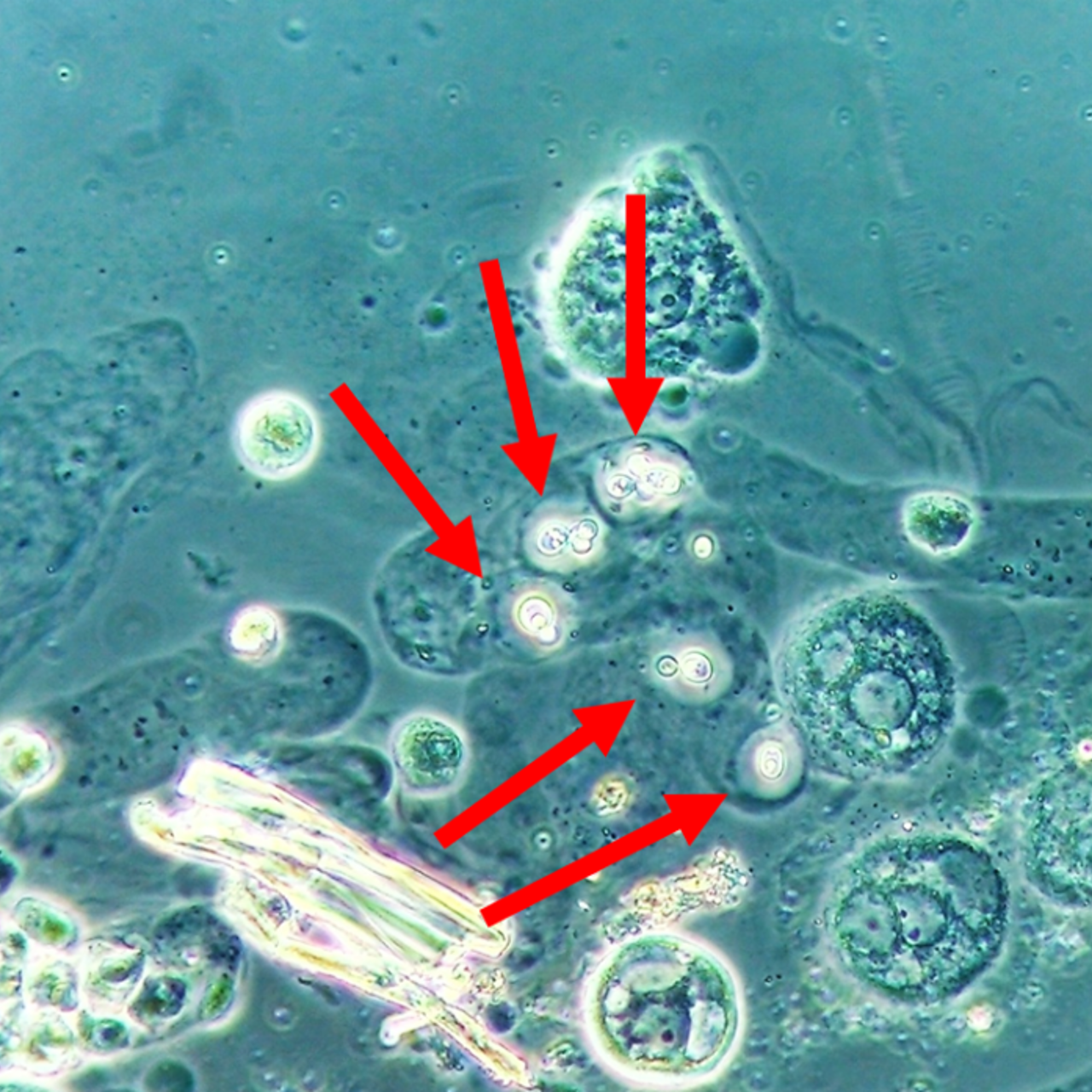 Cryptococcus spp. encapsuled yeasts entrapped within the proteinaceous matrix of the cast observed in the urine sediment. Imaged using ZEISS Primostar with phase contrast.