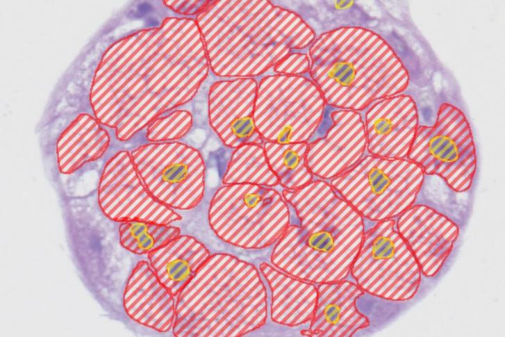 Microscopic view of a liver microtissue sample, featuring AI-generated markup. The hepatocyte is predominantly purple, with irregular red stripes indicating the cytoplasmic areas and yellow highlights marking the nuclei. This color differentiation emphasizes specific cellular structures and regions within the tissue, enhancing the visualization of cellular morphology.