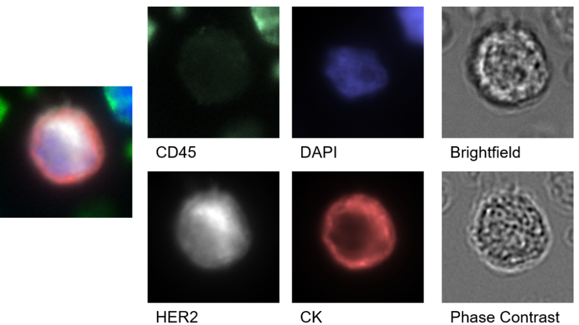 After scanning the entire slide, identified CTCs are imaged again at higher resolution for in depth analysis using automated, digital slide scanning with ZEISS Axioscan.