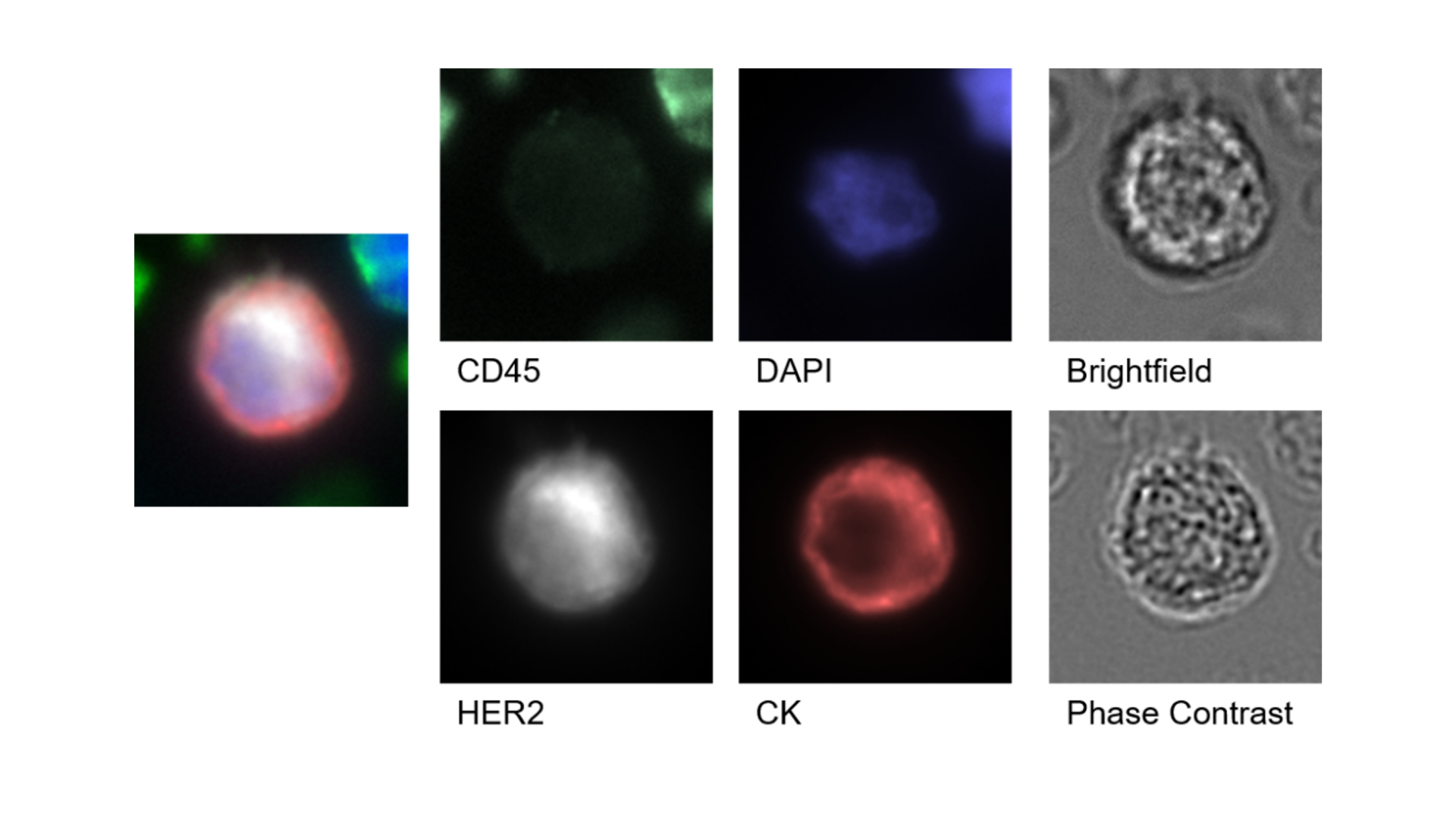 After scanning the entire slide, identified CTCs are imaged again at higher resolution for in depth analysis using automated, digital slide scanning with ZEISS Axioscan.