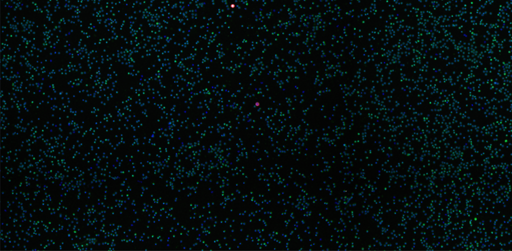 A blood sample with staining for DNA (blue), CK (red), CD45 (green), and AR-V7 (white). This example shows two CTCs indicated by CK (red) and a majority of white blood cells showing CD45 membrane marker (green). Acquisition was done with a ZEISS Axioscan digital slide scanner with a 10x objective.