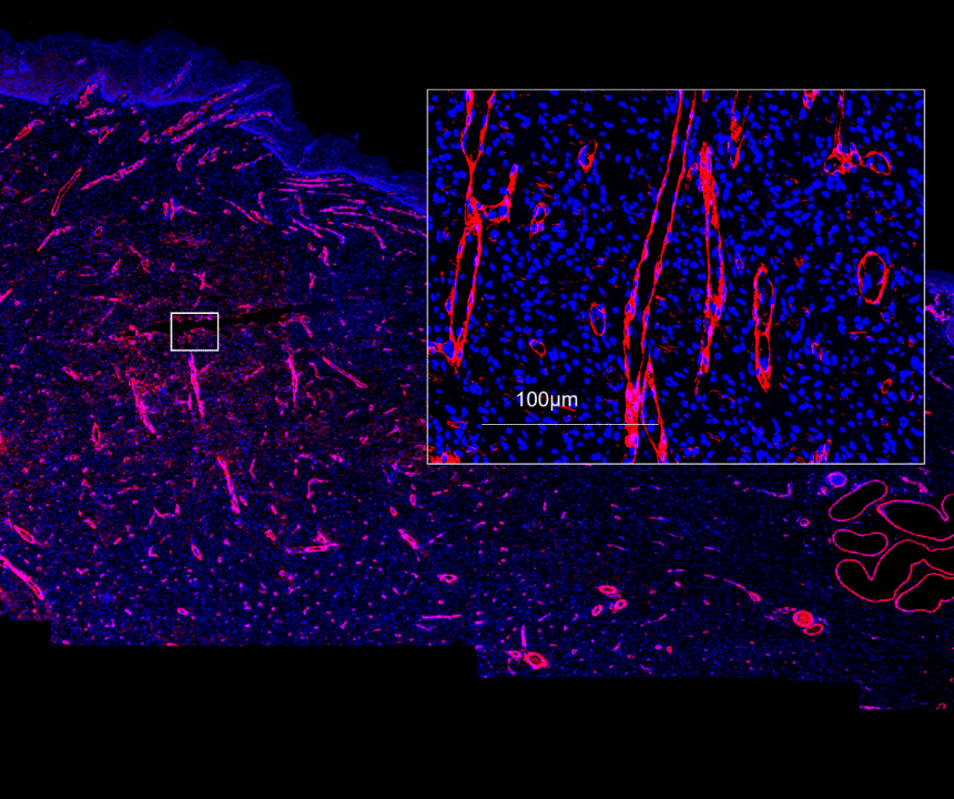 Biofilm infected porcine burn wound stained for smooth muscle actin (red) and nuclei (DAPI/blue). Image acquired with ZEISS Axioscan digital slide scanner.