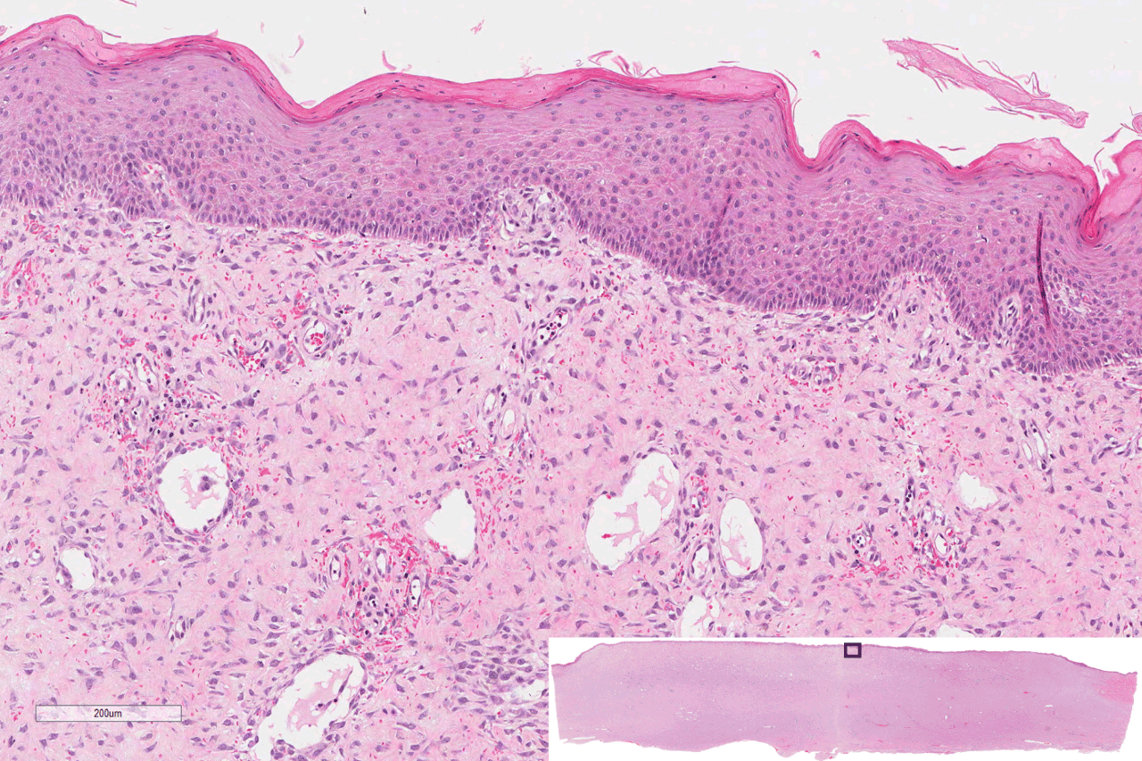 Hematoxylin and eosin-stained whole mount cross sections of infected porcine burn wounds showing re-epithelialization. Overview image is lower right. Imaged with ZEISS Axioscan.