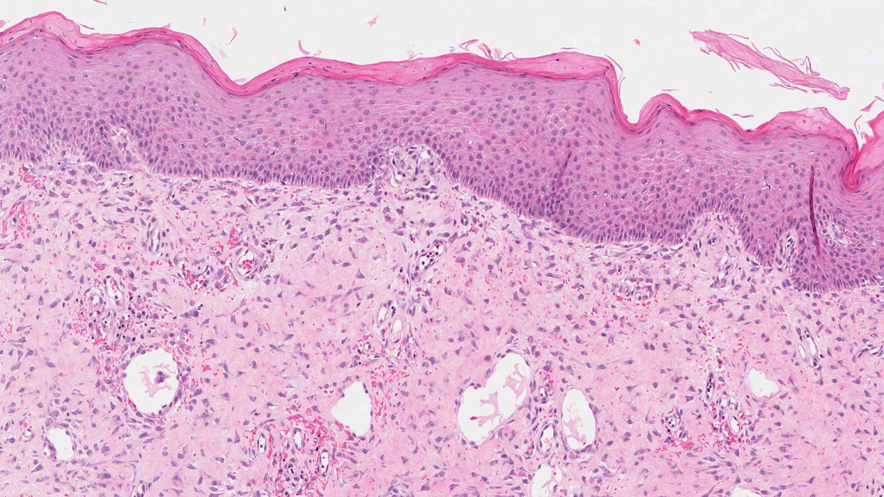 The Link Between Biofilm Infections and Wound Healing Investigated with Whole Slide Imaging