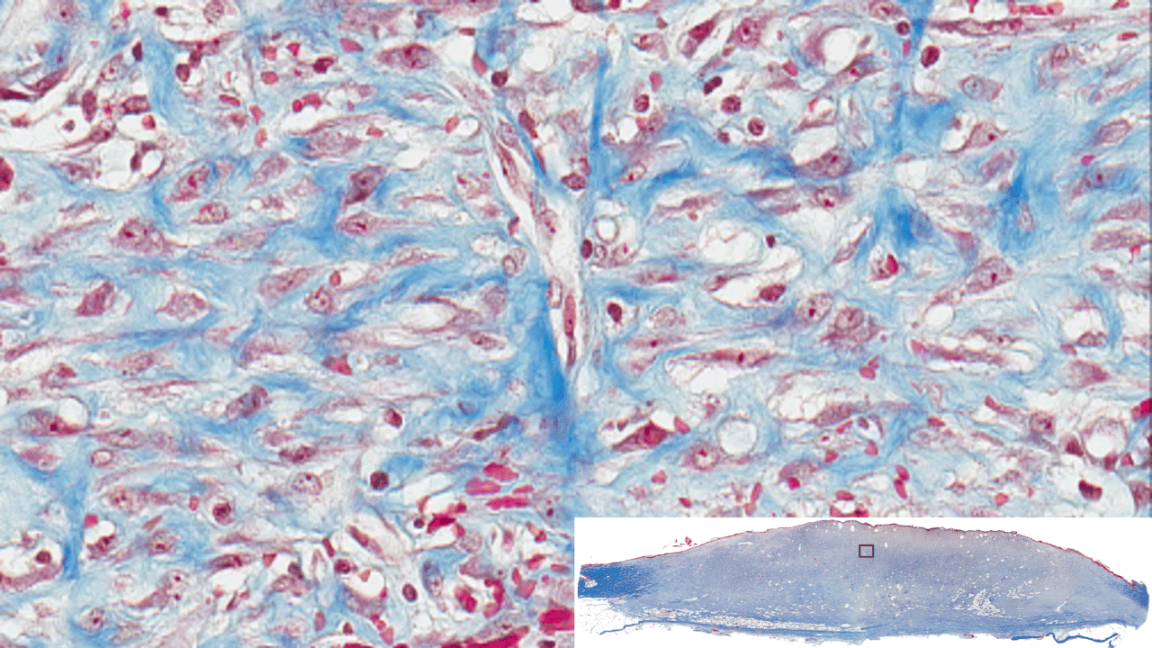 Masson’s trichrome staining of whole mount cross sections of infected porcine burn wounds. Staining results in blue-black nuclei, blue collagen, and light pink/red cytoplasm. Epidermal cells appear reddish. Imaged with ZEISS Axioscan digital slide scanner.