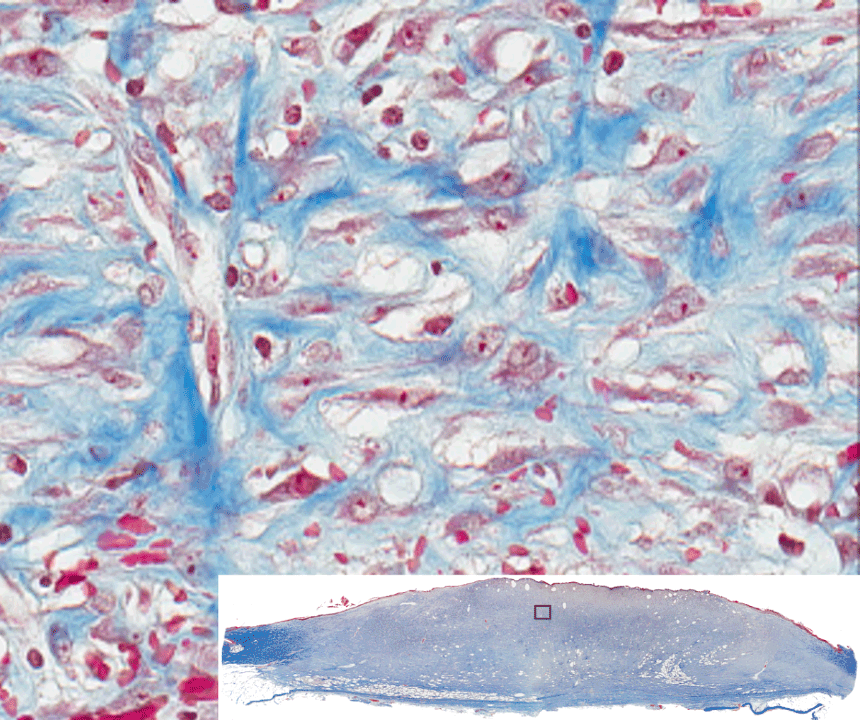 Masson’s trichrome staining of whole mount cross sections of infected porcine burn wounds. Staining results in blue-black nuclei, blue collagen, and light pink/red cytoplasm. Epidermal cells appear reddish. Imaged with ZEISS Axioscan digital slide scanner.