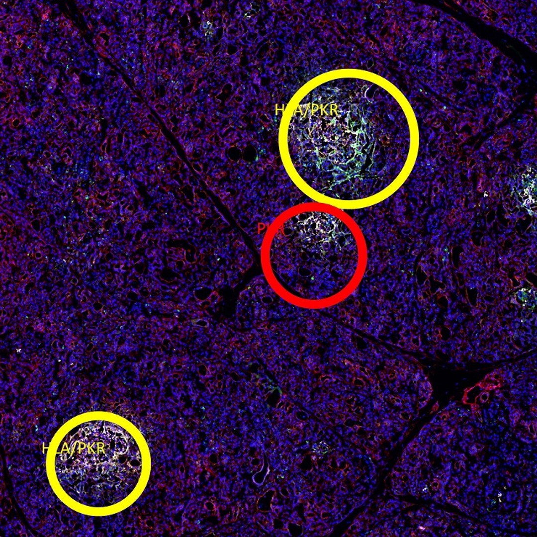 Middle inset of A whole pancreatic tissue section. Each positive islet was assigned a colored circle based on the number of expressed interferon response markers as follows: red for the expression of one marker, yellow for two markers, purple for three markers, and blue for four markers. Scale bar is 290 microns.