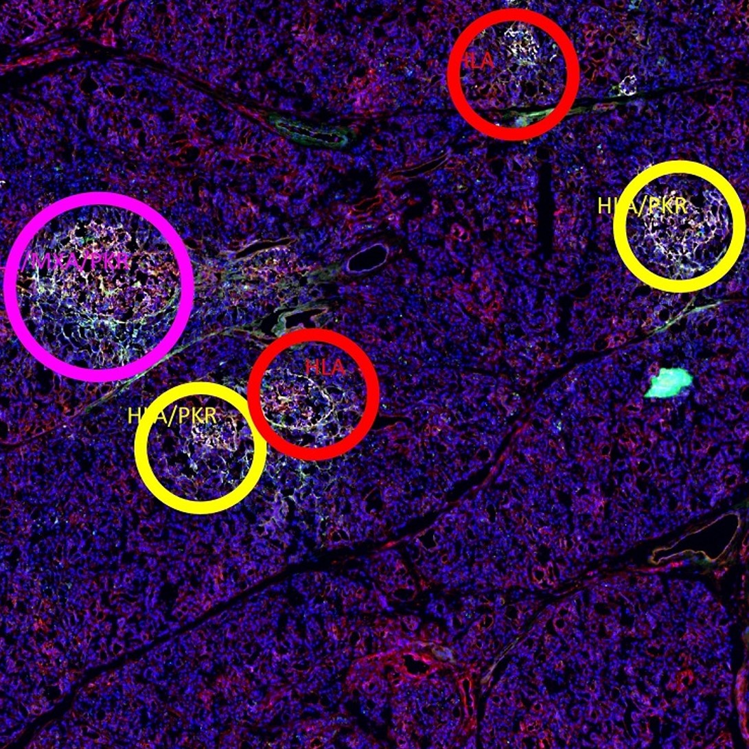 Lower inset of A whole pancreatic tissue section. Each positive islet was assigned a colored circle based on the number of expressed interferon response markers as follows: red for the expression of one marker, yellow for two markers, purple for three markers, and blue for four markers. Scale bar is 290 microns.