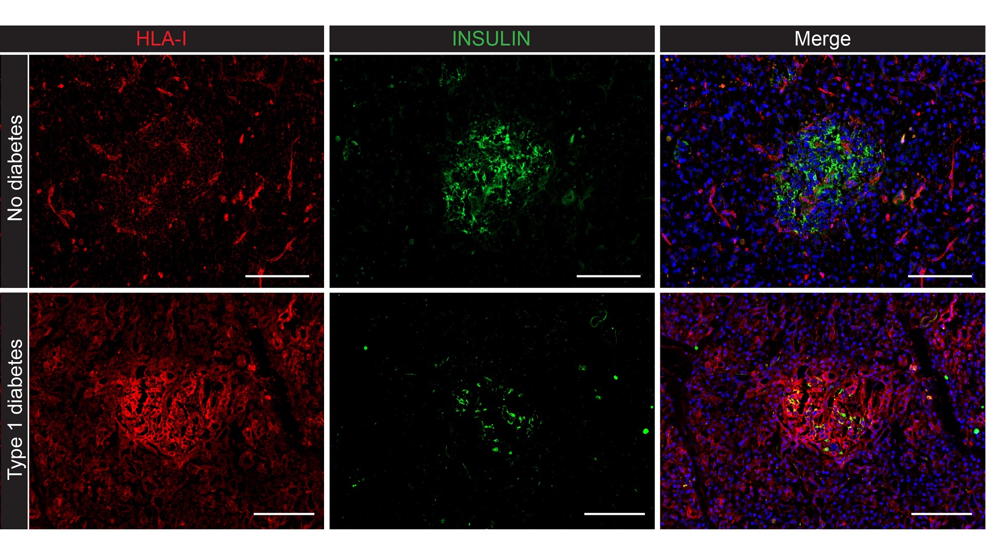 The islets of Langerhans from a non-diabetic donor showing normal HLA-I expression (top), and a type 1 diabetic donor with high expression of the interferon sensor HLA-I (bottom). Scale bars are 100 μm. Image collected using automated whole slide scanning with ZEISS Axioscan.