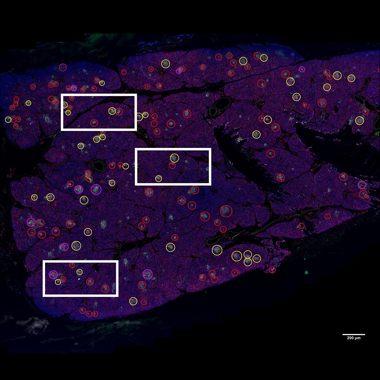 A whole pancreatic tissue section. Each positive islet was assigned a colored circle based on the number of expressed interferon response markers as follows: red for the expression of one marker, yellow for two markers, purple for three markers, and blue for four markers. Scale bar is 290 microns.