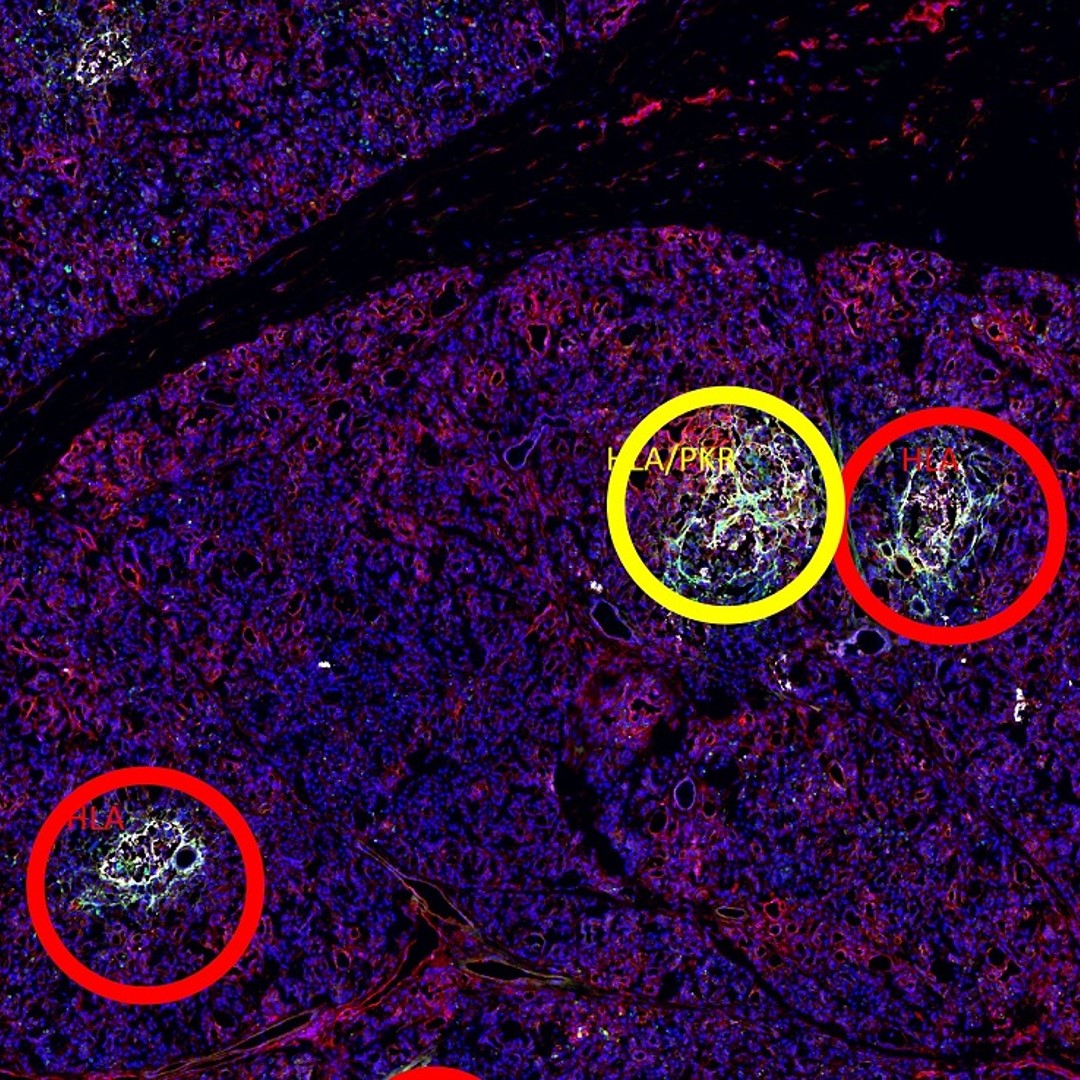 Upper inset of A whole pancreatic tissue section. Each positive islet was assigned a colored circle based on the number of expressed interferon response markers as follows: red for the expression of one marker, yellow for two markers, purple for three markers, and blue for four markers. Scale bar is 290 microns.