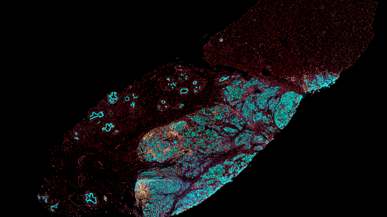 Seven color multiplex immunofluorescence of breast cancer tissue