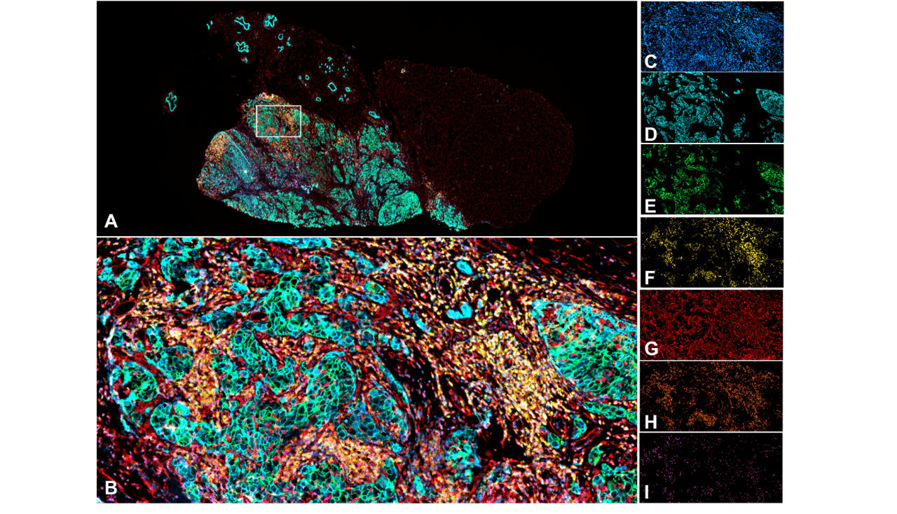 Seven color panel on human breast cancer FFPE section