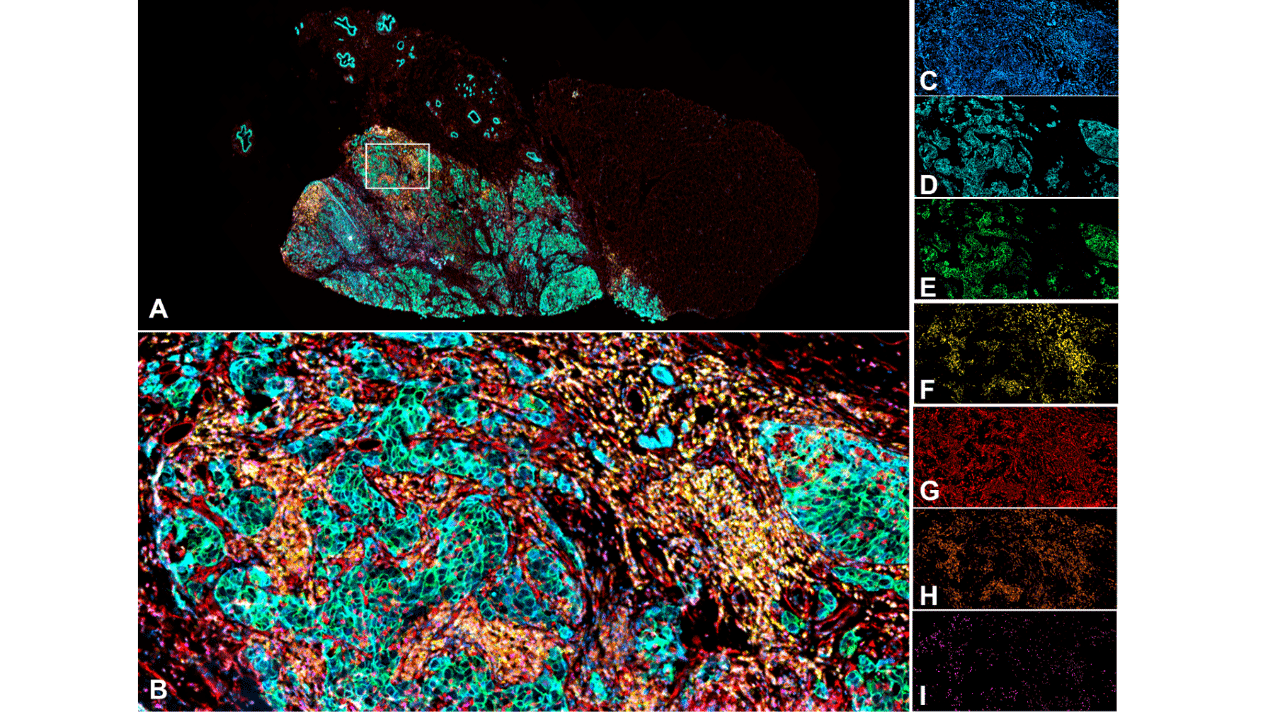 Seven color panel on human breast cancer FFPE section