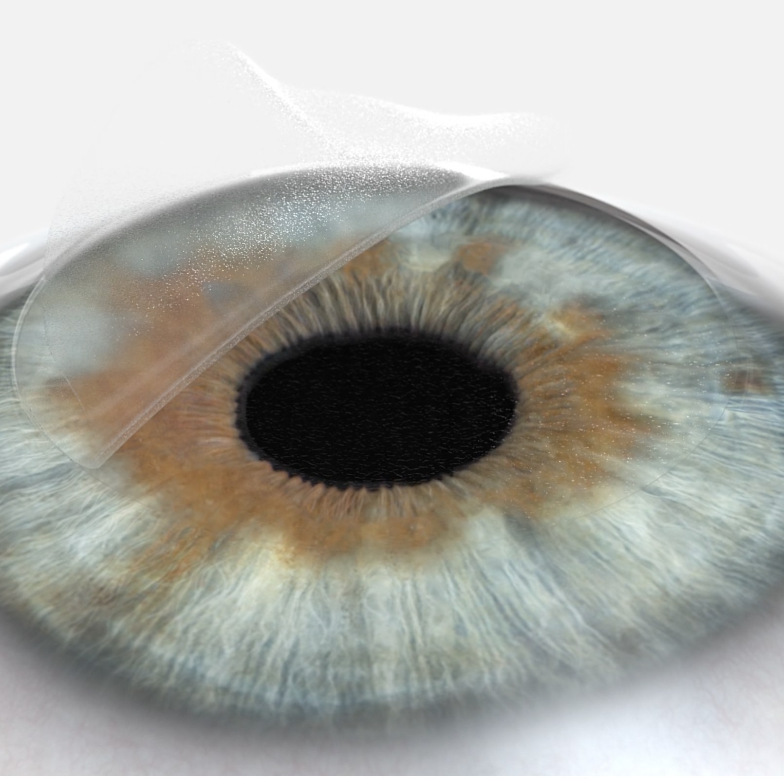 Close-up 3D rendering of a human eye with the corneal flap lifted, showing the LASIK procedure in progress.