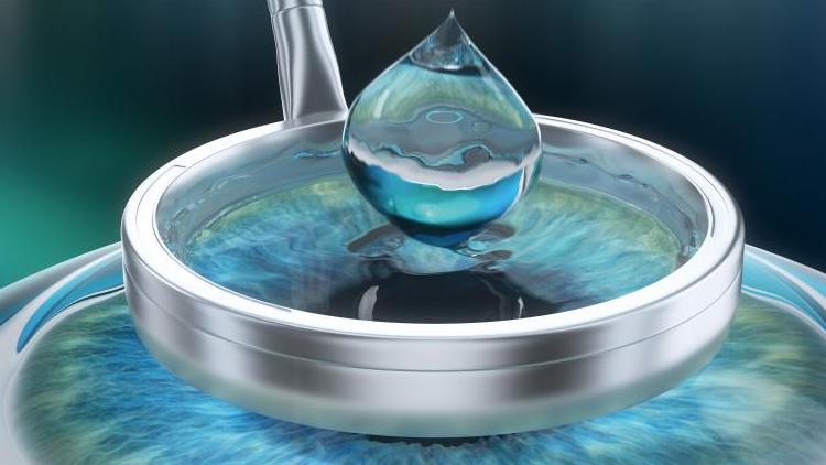 Alcohol solution being applied to the cornea to dissolve the epithelial layer in preparation for PRK eye surgery.