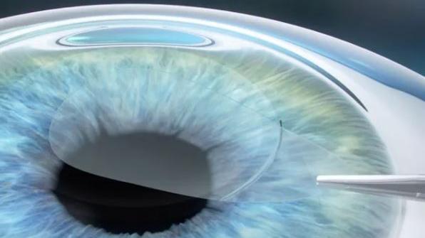 Eye undergoing minimally invasive lenticule removal during the lenticule extraction with ZEISS SMILE pro through a small laser-created opening.