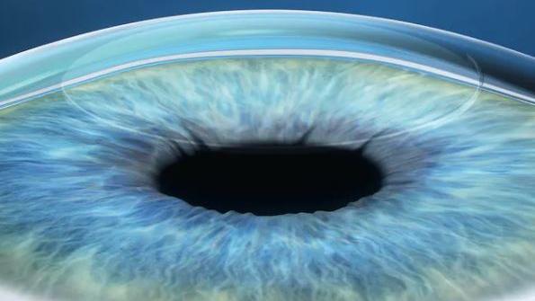 Cornea after lenticule removal, with small incision visible and surface reshaped for vision correction.