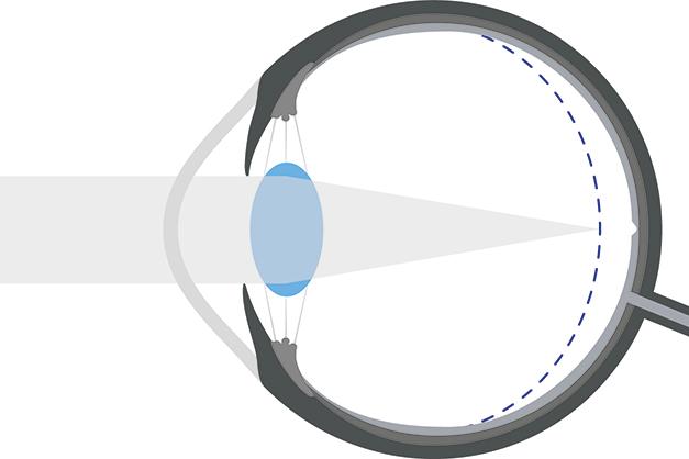 Graphic of a myopic eye
