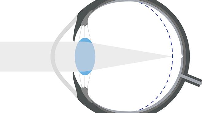 Graphic of myopic eye